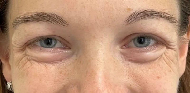 Crow's Feet and Under-Eye Fine Lines: What Actually Works After 40