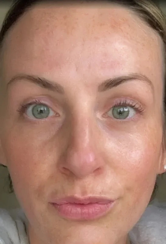 Close-up of a person's face with visible skin texture and freckles. After image (more even skin).
