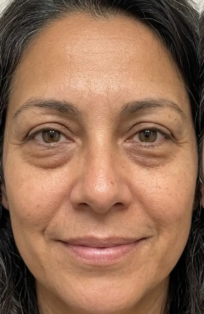 Why Your Eye Bags Got Worse After 40 (And What Actually Reduces Them)