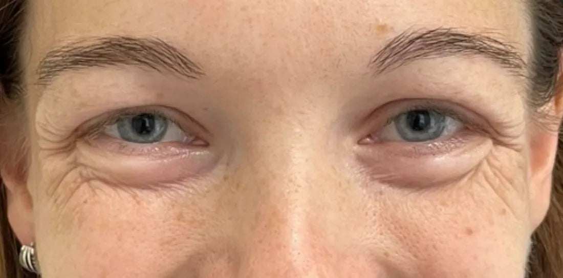 Crow's Feet and Under-Eye Fine Lines: What Actually Works After 40