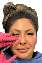 Fillers & Surgery