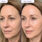 Customer before after GlowUp LED mask [dull tired skin, wrinkles]