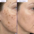 Customer after weeks of GlowUp LED therapy — clearer complexion