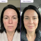 Customer before-after using GlowUp LED mask [breakouts/redness]