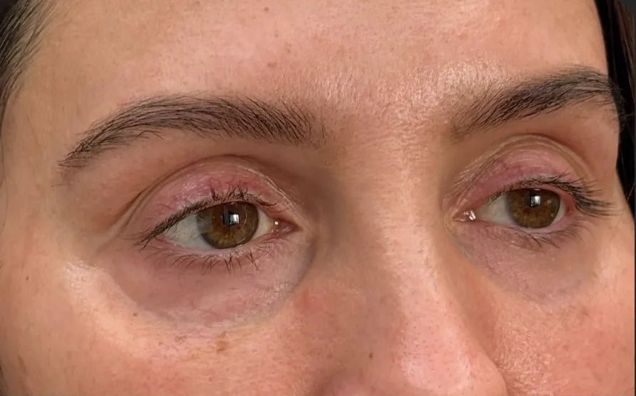 Why Your Dark Circles Won't Lighten (It's Probably the Tear Trough)